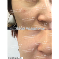 印第安纹剥离1次效果 