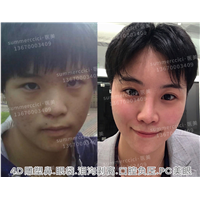 全脸剥离半年后 
