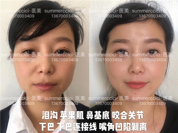 鼻基底剥离1年多效果 