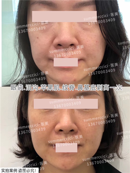 泪沟剥离1次效果 