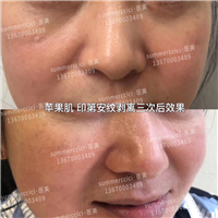 印第安纹苹果肌剥离3次后 