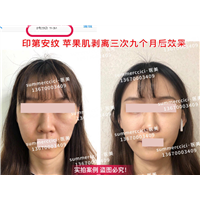印第安纹剥离三次后 