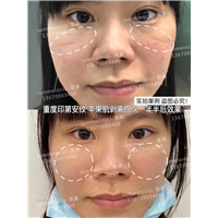 印第安纹剥离4次后效果 