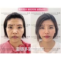 全脸剥离8个月 