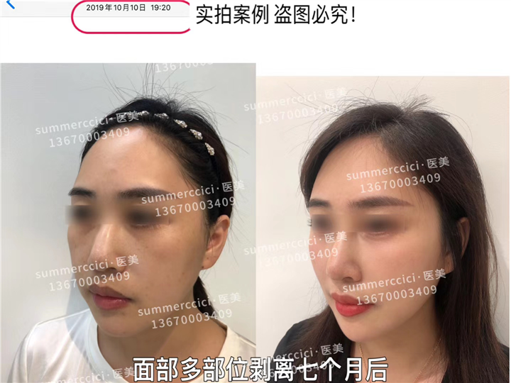 印第安纹剥离七个月后 