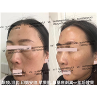 印第安纹剥离1年后效果 