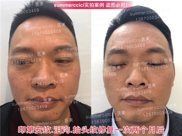 印第安纹剥离1次后效果 