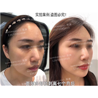 印第安纹7个月后效果 