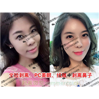 皮下剥离微雕|面部剥离术