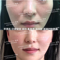 面颊凹陷剥离后 