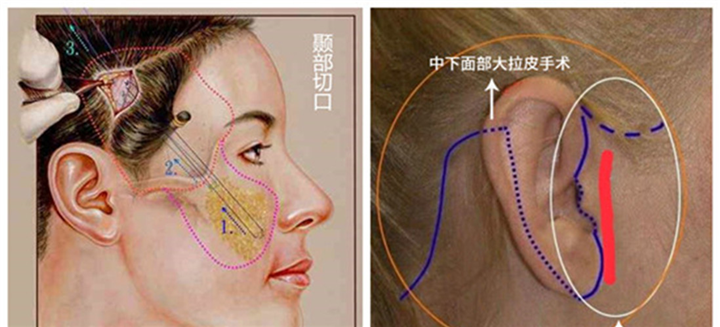 拉皮可以改善印第安纹吗？印第安纹去做拉皮好还是剥离好？