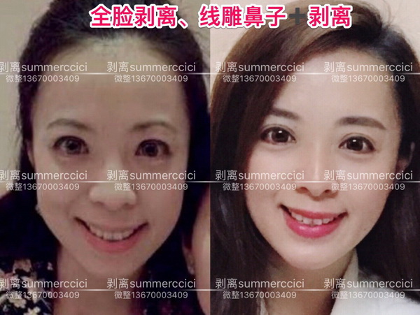 剥离微整价格|三维剥离