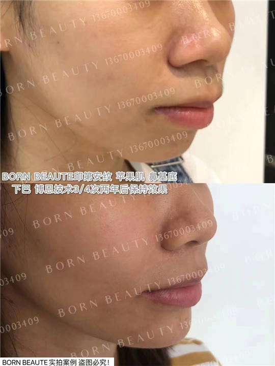 印第安纹填充和印第安纹剥离，哪个效果好？