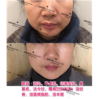 鼻基底剥离1年 