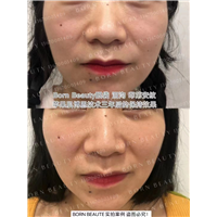 印第安纹剥离技术真的有那么好吗？手术有风险吗？