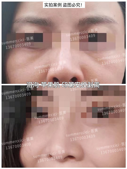 印第安纹剥离2次效果 