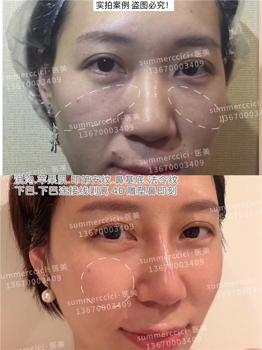 印第安纹剥离3年后 
