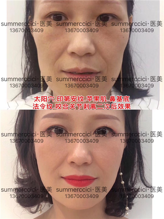 全脸剥离一年后 
