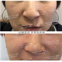 印第安纹苹果肌剥离1次效果 