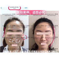 鼻基底剥离3年多 
