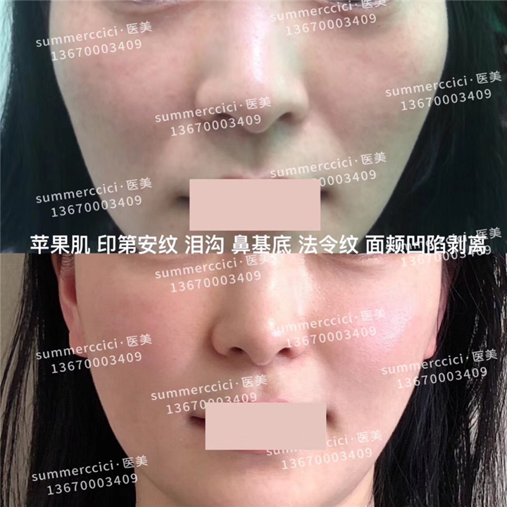 印第安纹剥离3次后效果 