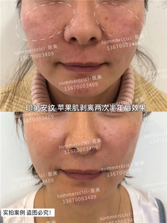 印第安纹苹果肌剥离半年后 