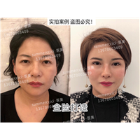 全脸剥离1年多 