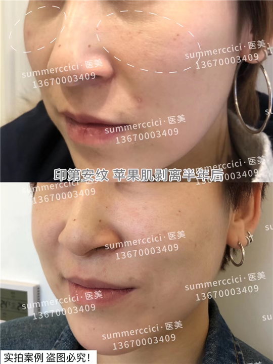 印第安纹剥离半年后效果 