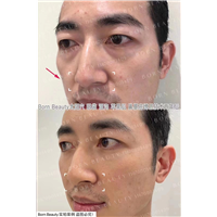 印第安纹怎么改善好？针灸和按  摩有效果吗？