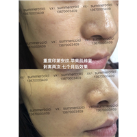 印第安纹加苹果肌剥离2次后效果 