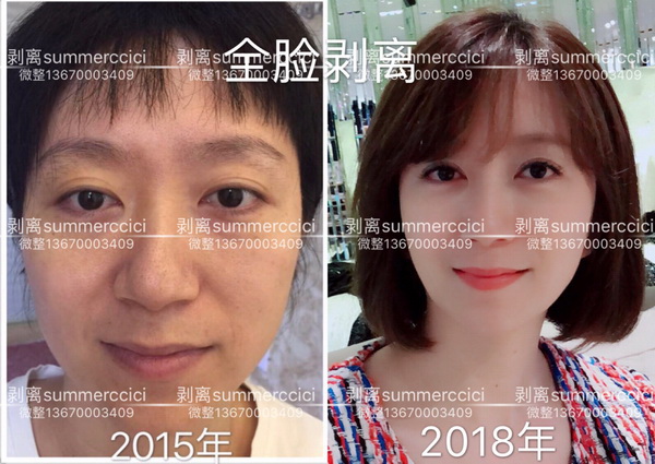 剥离微雕多少钱|剥离微整价格