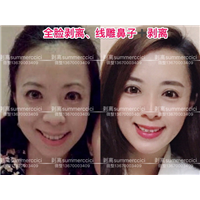 剥离微整价格|三维剥离