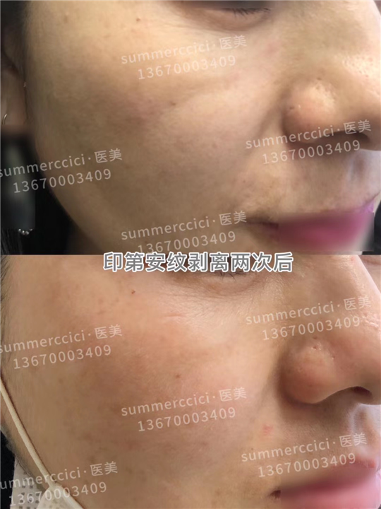 印第安纹剥离2次后 