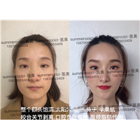全脸剥离1年效果 