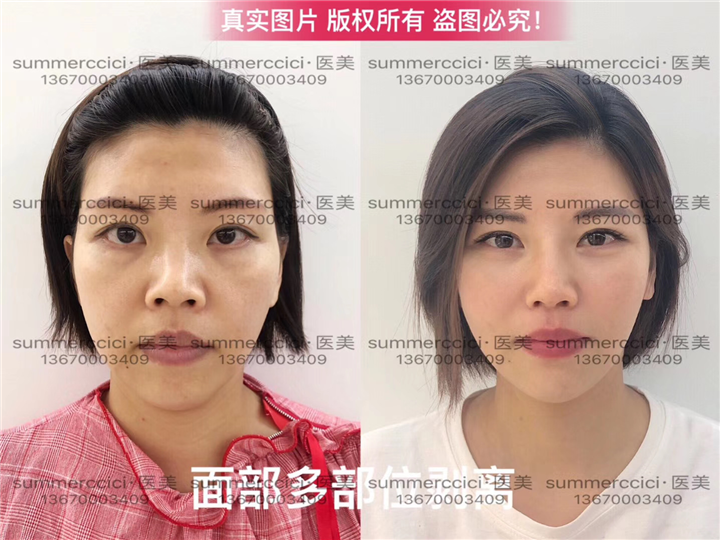 全脸剥离8个月 