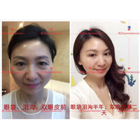 剥离微整|剥离微雕