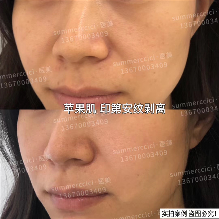 印第安纹苹果肌剥离 