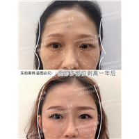 印第安纹剥离一年后