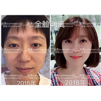 剥离微雕多少钱|剥离微整价格