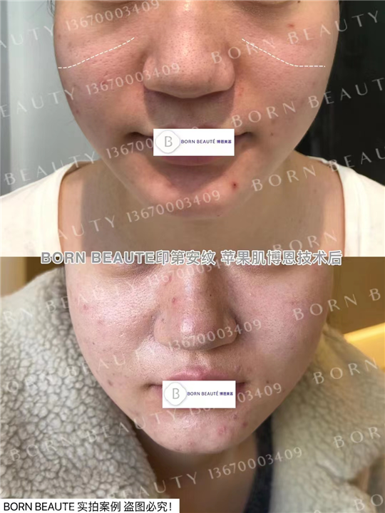 印第安纹剥离安全吗？有没有副作用啊?