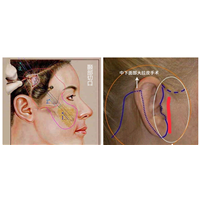 拉皮可以改善印第安纹吗？印第安纹去做拉皮好还是剥离好？