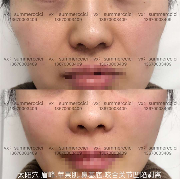 鼻基底剥离两次后效果 