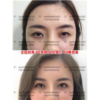 pc美眼3年效果 