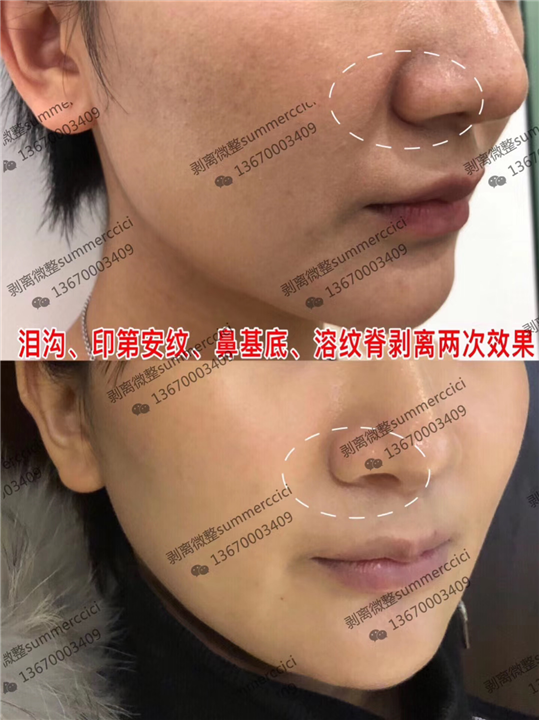 鼻基底剥离两次 