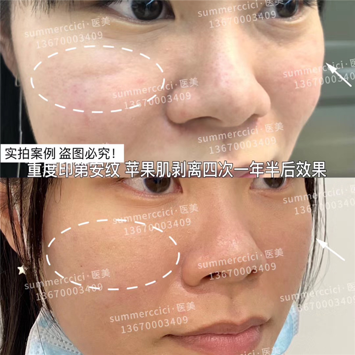 印第安纹剥离4次后效果 