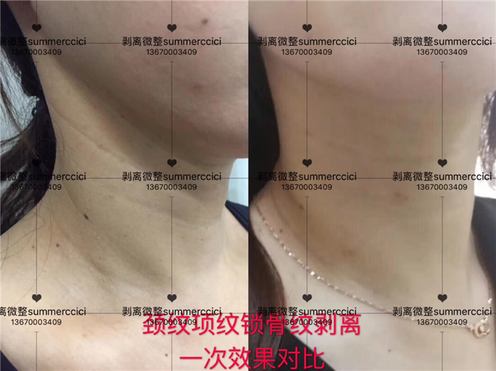 颈纹剥离1次效果 
