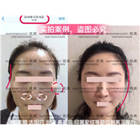 脸部多部位剥离三年后 