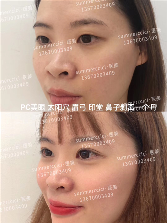 pc美眼1个月效果 