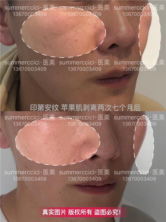 印第安纹剥离2次后 