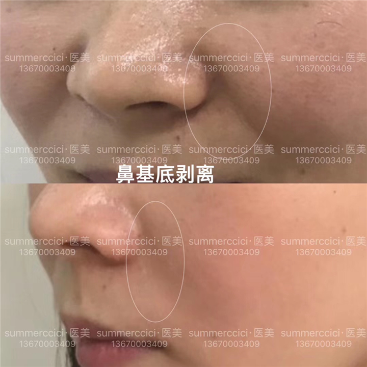 鼻基底剥离5个月效果 